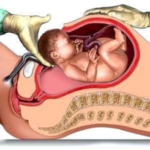 cesarean