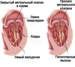 Додаткова хорда