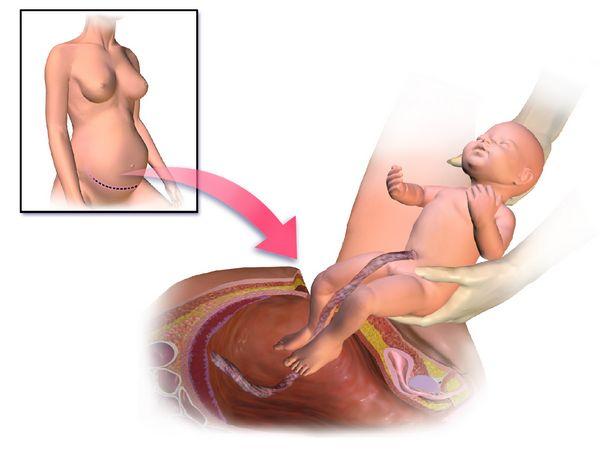 Caesarean section and its implications