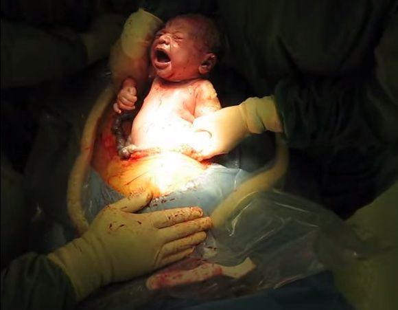 Having a baby by cesarean section