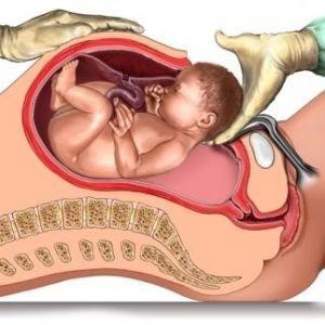 Preparing for a Cesarean section