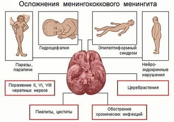 осложнения после минингита