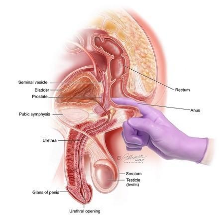 Простата - миниобзор глазами патолога