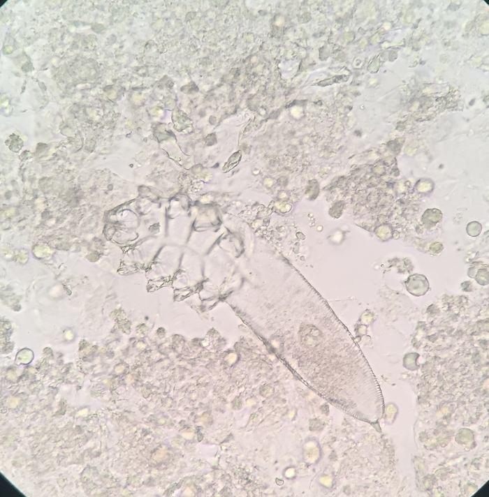 demodex