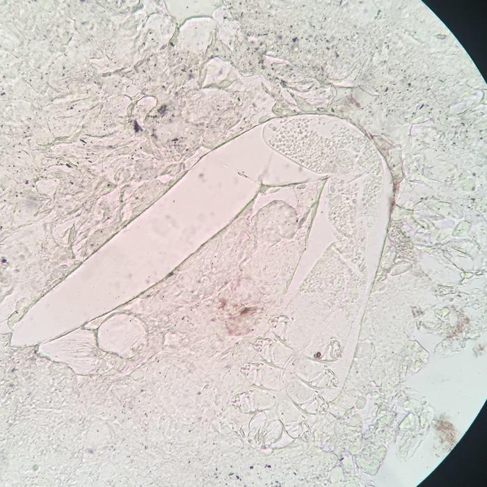 demodex